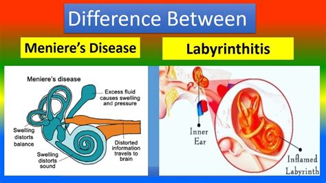 Difference Between Menieres Disease And Labyrinthitis Youtube