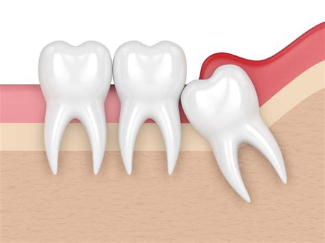 Impacted Wisdom Tooth Everything You Should Know And Do
