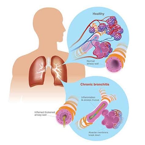 Chronic Bronchitis Symptoms And Treatment Of Chronic Bronchitis
