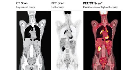 At Risk Coronary Patients Aided By Petct Image Assessments