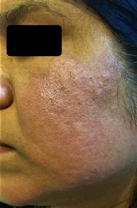 Erythema With Mild Swelling Is Noted On The Left Side Of The Face In A