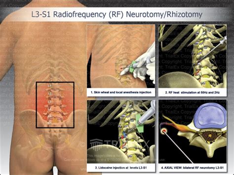 L3 S1 Radiofrequency Rf Neurotomyrhizotomy Trial Exhibits In