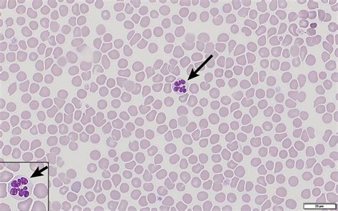 Botryoid Neutrophils And Inappropriate Rubricytosis In A Dog Clinician