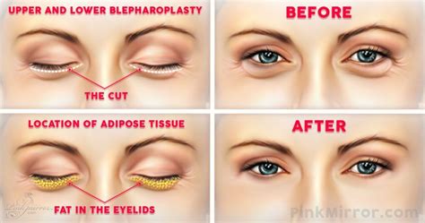 How To Minimise The Appearance Of Under Eye Bags Surgery To Get Rid Of