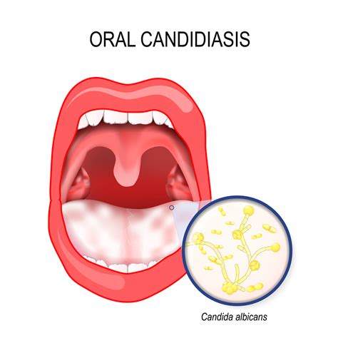 Oral Thrush Causes Symptoms And Remedies Smilekeepers