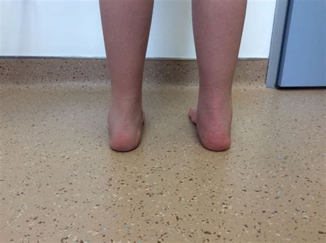 Flat Feet In Children Ottawa Foot Clinic