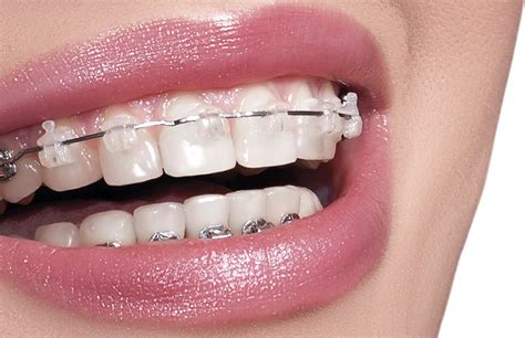 Ortodoncia Clínica Dental Y Maxilofacial Dr Fontanillo