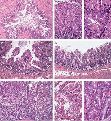Dysplastic Serrated Polyps Of The Appendix Serrated Adenomas Panels