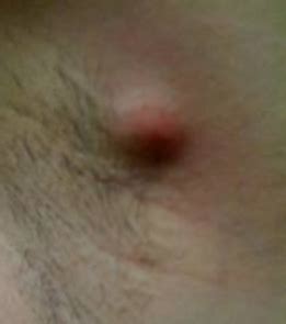 Ingrown armpit hair, bump, lump or cyst can be painful especially if it gets infected. Lump under armpit, Painful, That Hurts Male, Female, Pea ...