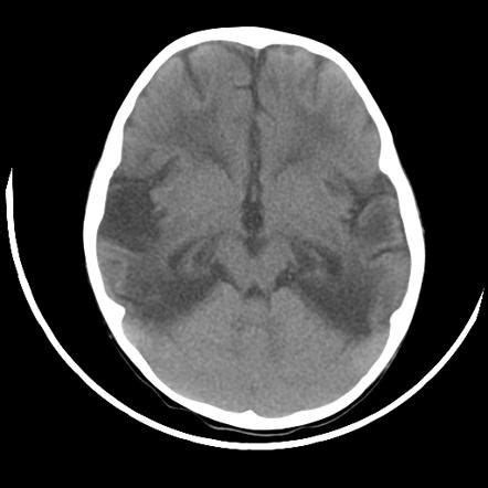 Severe viral infection of the central nervous system, caused by a herpes simplex virus and usually localised to the temporal and frontal lobe; HSV encephalitis | Image | Radiopaedia.org
