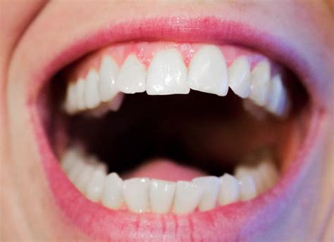 Why Do My Teeth Hurt When It Rains Marc Allen Orthodontics