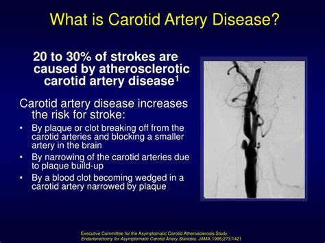 Internal Carotid Artery Stroke Symptoms