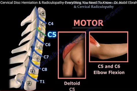 Neck Pain Cervical Disc Herniation And Radiculopathy OrthopaedicPrinciples Com