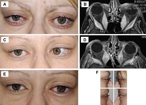 Surgical Treatment Of Graves Ophthalmopathy Semantic Scholar