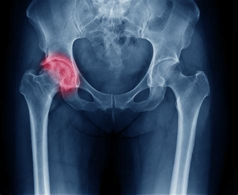 Hip Fractures And How They Affect The Elderly In Assisted Living Facilities
