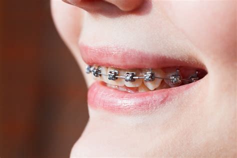 An Overview About Underbite Braces