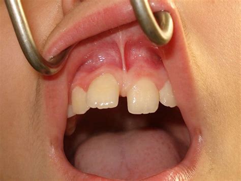 Upper Lip Laser Frenectomy Without Infiltrated Anaesthesia In A Paediatric Patient A Case