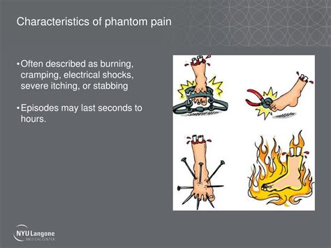Ppt Phantom Limb Pain Current Theories And Evidence Based Treatments