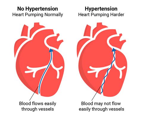Find out what you can do to control it. More Than a Measurement: Hypertension | A&D Medical