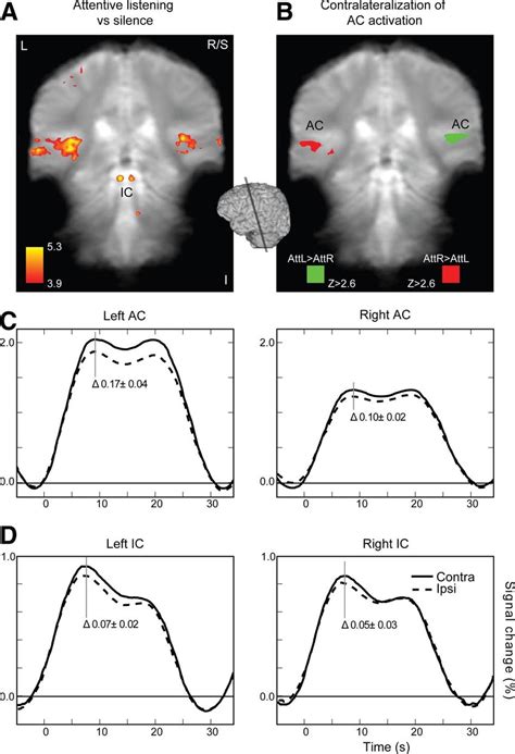 Functional Mri Fmri Results A Attentive Listening To The Sounds