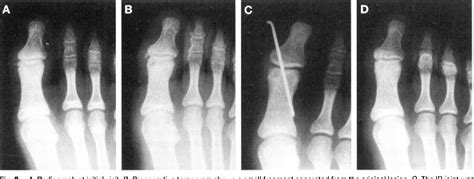 Figure 2 From Osteochondral Lesions Of The Proximal Phalanx Of The