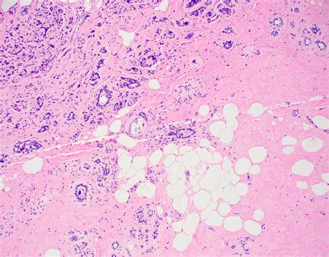 Pathology Outlines Sclerosing Adenosis