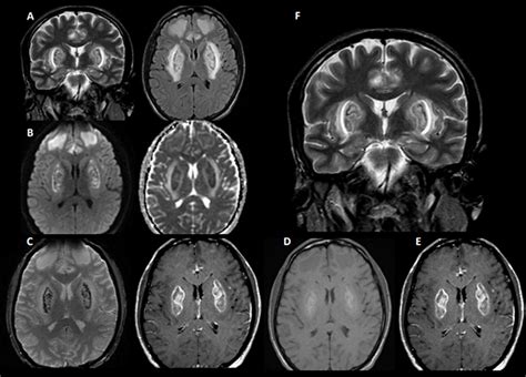 Cureus Bilateral And Symmetrical Lesions In The Basal Ganglia Associated With Metabolic