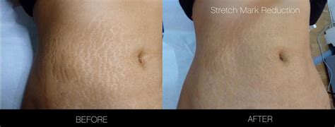 Lovely Stretch Marks Before And After Weight Loss Men Wallpaper Craft