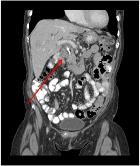Contrast Enhanced Coronal Ct Image Demonstrates An Ill Open I