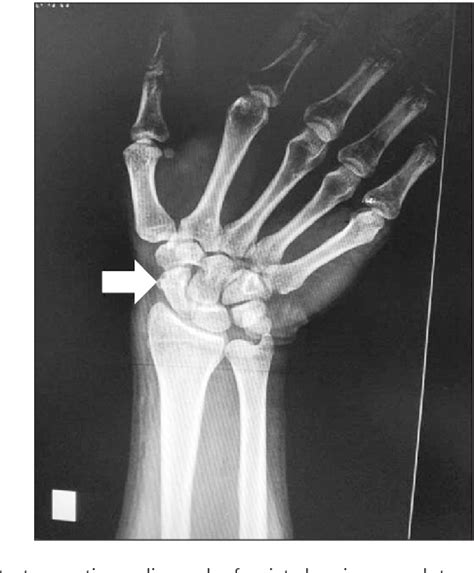 Intraosseous Ganglion Cyst Of Scaphoid An Uncommon Cause Of Radial Wrist Pain Semantic Scholar
