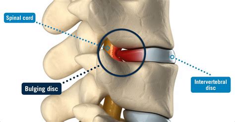 Symptoms for a bulging disk in the back include pain felt in the pelvic region. Bulging Disc | USA Spine Care | Laser Spine Surgery