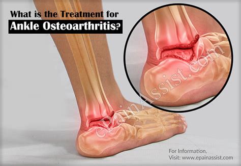 Ankle Osteoarthritiscausessymptomstreatmentrecoverydiagnosis