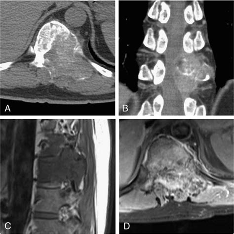 Malignant Peripheral Nerve Sheath Tumor In Spine Imaging