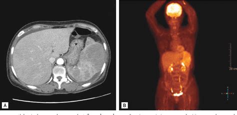 Figure 1 From A Rare Case Of Rosai Dorfman Disease Without