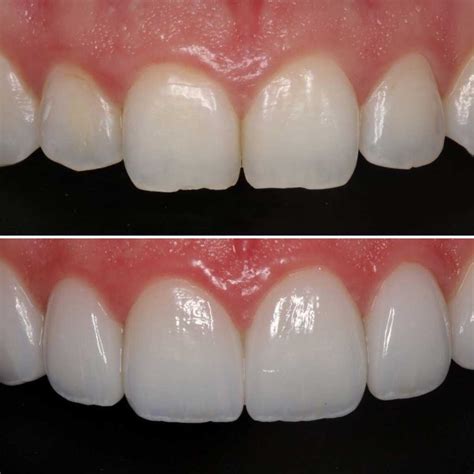What Are Veneers Total Care Dental Holistic Dentistry