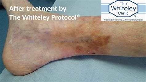 Venous Leg Ulcer Cured By The Whiteley Protocol®