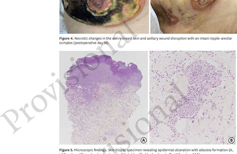 Figure 5 From Pyoderma Gangrenosum Mimicking Wound Infection After