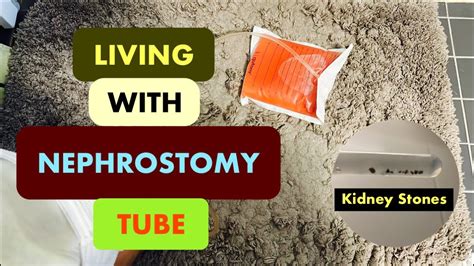 Nephrostomy Tube Nefrostomi Nephrostomy Journey Nephrostomy Tube