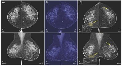 Screening for breast cancer includes activities which test members of asymptomatic populations for there are few areas in imaging fraught with more controversy than screening for breast cancer. AI Models Predict Breast Cancer with Radiologist-Level ...