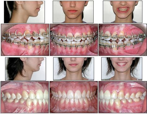 Orthodontic Finishing Ten Steps To Success Apos Trends In Orthodontics