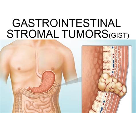Gastrointestinal Stromal Tumors Gist Overviewfull 1st For Credible News