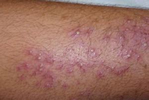 There are many home remedies to treat these rashes; Itchy Lower Legs - Causes, Red Rash, How To Get Rid ...