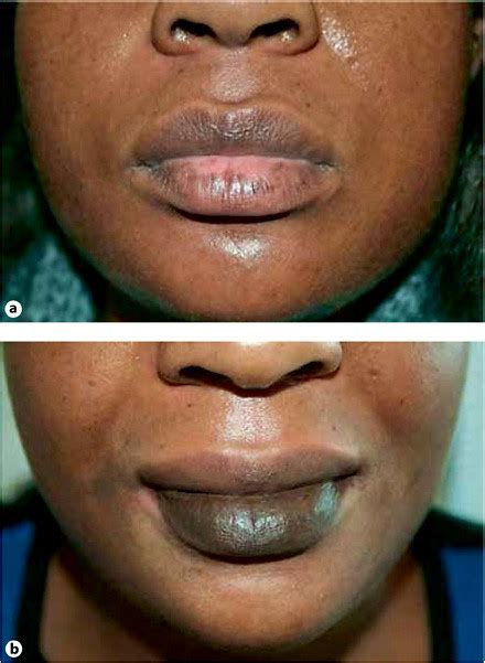 Vitiligo Lip Correction Before A And After B Courtesy Of Rika