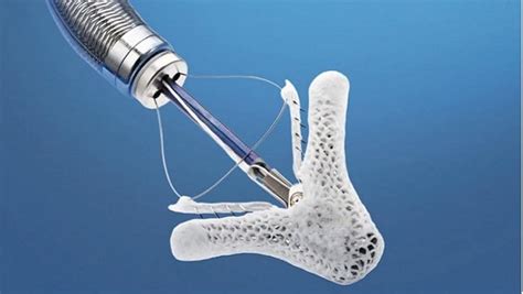 Abbotts Mitraclip Approved As First Transcatheter Mitral Valve Repair