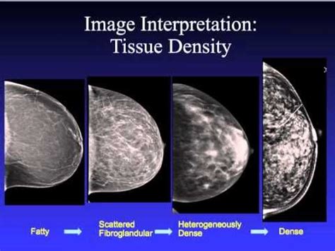 How To Read A Mammogram Youtube Mammography Diagnostic Medical