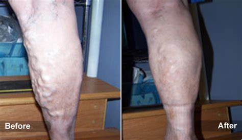 Spider And Varicose Veins Laser Treatment Before And After St Louis
