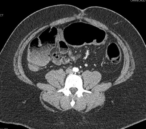 Pneumatosis Coli Best Seen On Lung Windows Colon Case Studies