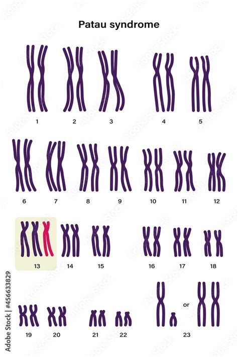 Human Karyotype Of Patau Syndrome Autosomal Abnormalities Patau Syndrome Have An Extra Copy Of