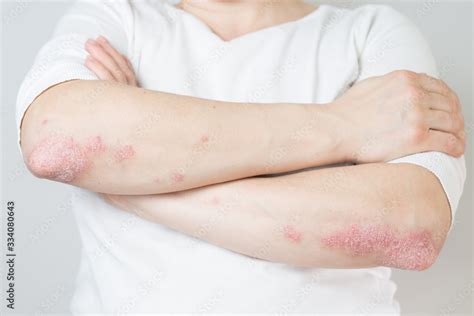 Acute Psoriasis On Elbows Is An Autoimmune Incurable Dermatological