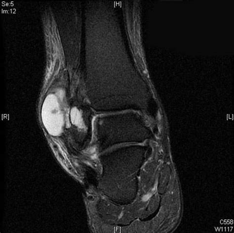 Ganglion Cyst The Foot And Ankle Online Journal